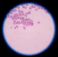 pseudotrombocitopenia ou aglomeração de plaquetas como uma possível causa foto