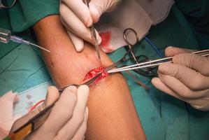 operação de fístula arteriovenosa para paciente
