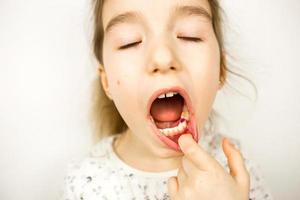 enchimento roxo colorido no dente de mascar leite da menina. odontopediatria, tratamento e exame. uma criança com a boca aberta mostra um dente em close-up em um fundo branco. foto