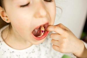 enchimento roxo colorido no dente de mascar leite da menina. odontopediatria, tratamento e exame. uma criança com a boca aberta mostra um dente em close-up em um fundo branco. foto