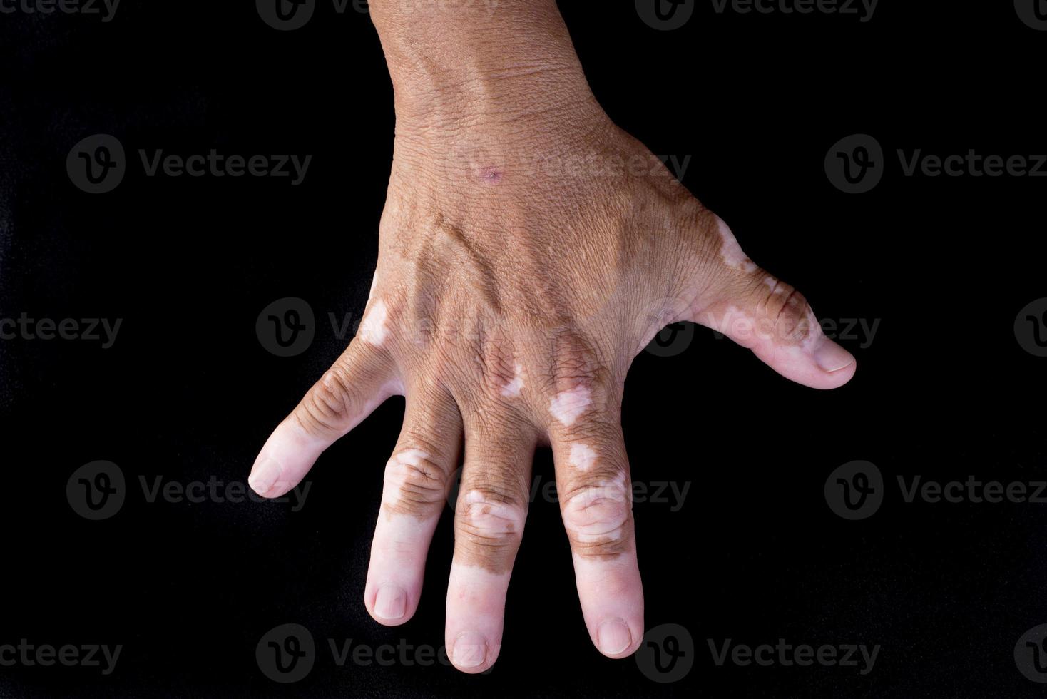 Quadrichrom Vitiligo foto