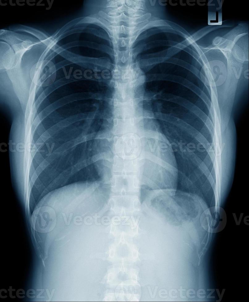 Röntgenbild des Brustkorbs Blauton foto