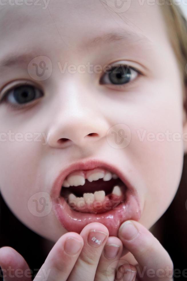 kleines Mädchen ohne Zahn lächelnd foto