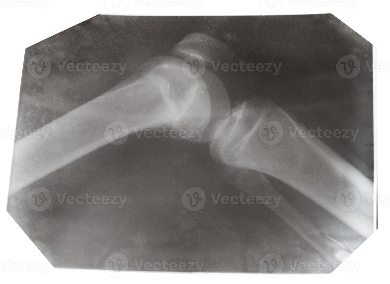 röntgenfoto des menschlichen kniegelenks isoliert foto