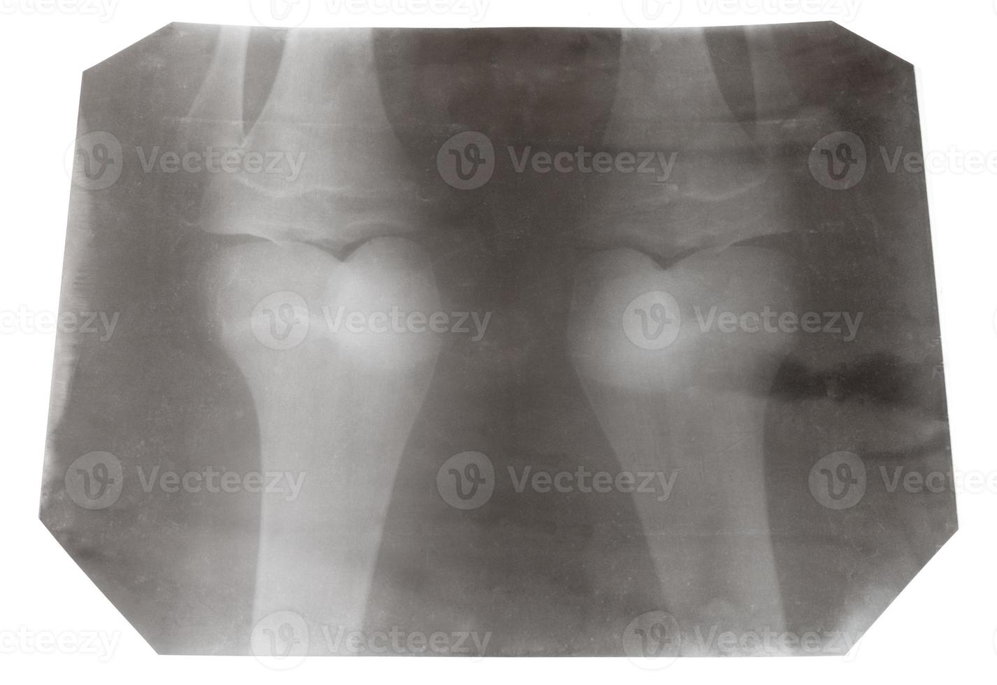 Röntgenbild von zwei menschlichen Kniegelenken isoliert foto