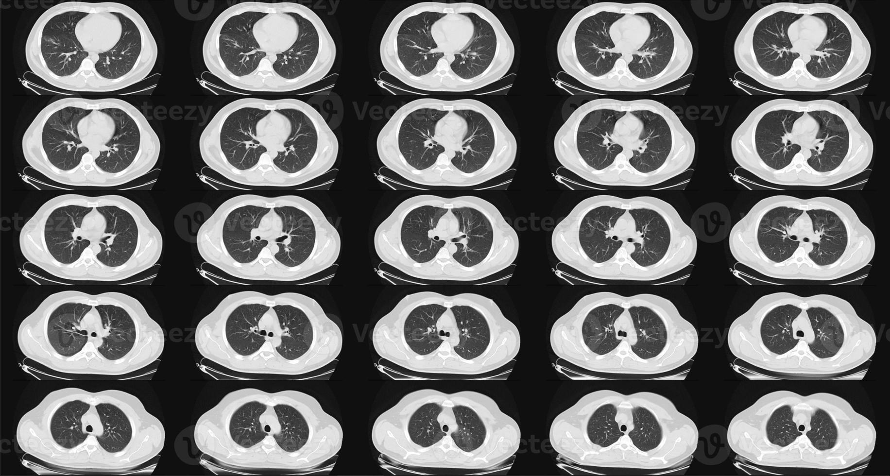 Computertomographie der Lunge bei einem gesunden erwachsenen Mann. normaler Lungen-CT-Scan. kann Teil der Covid-19-Diagnostik sein. foto