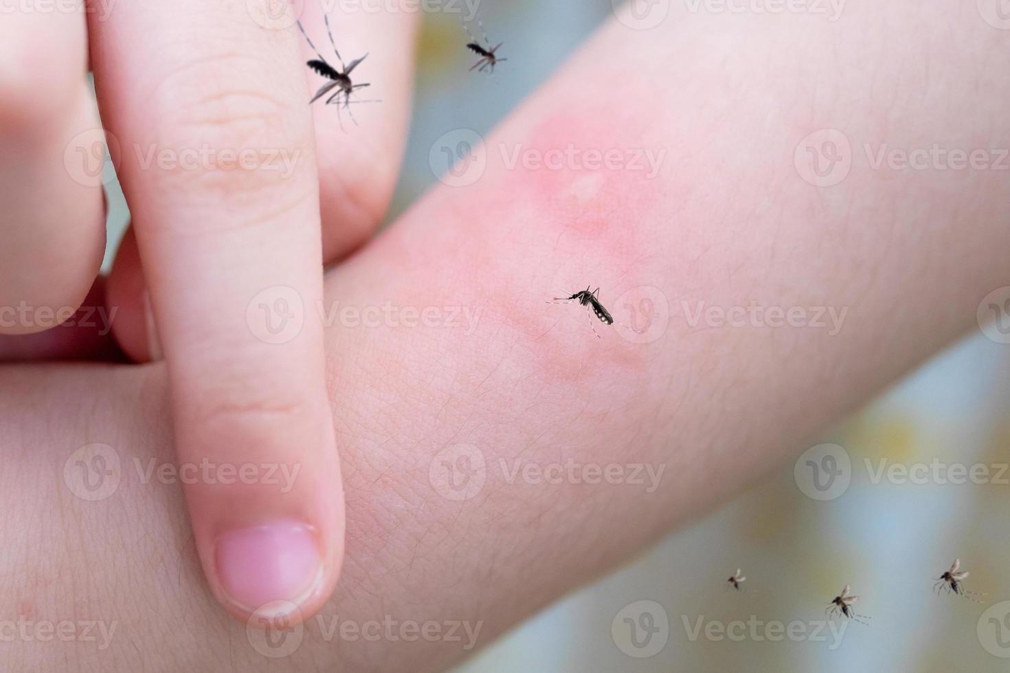 Kleines Mädchen hat eine Hautausschlagallergie, die mit Mückenstich am Arm juckt und kratzt foto