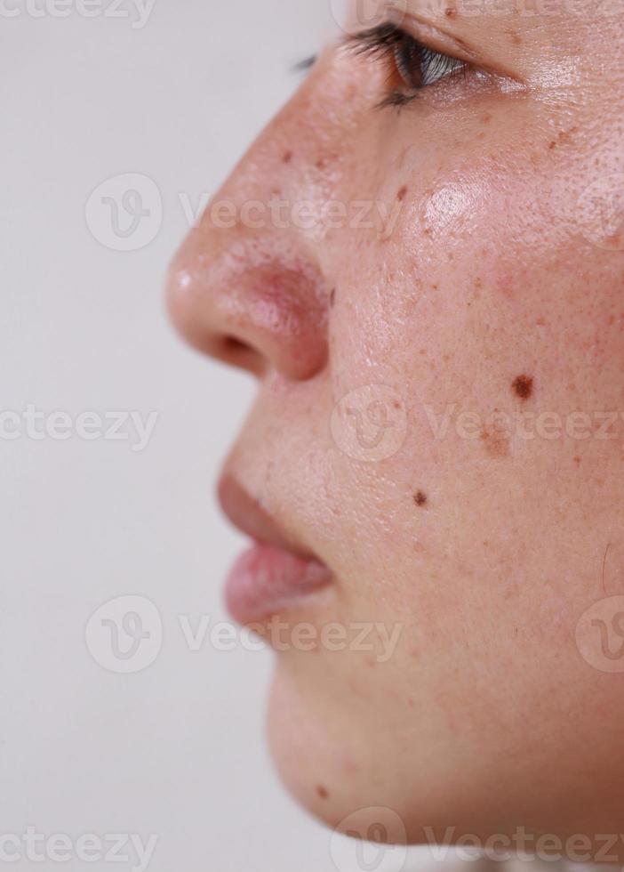 halbes Gesicht einer Frau mit schwarzen Punkten öliges Gesicht Hautgesundheitsprobleme zur Behandlung eines Dermatologen foto