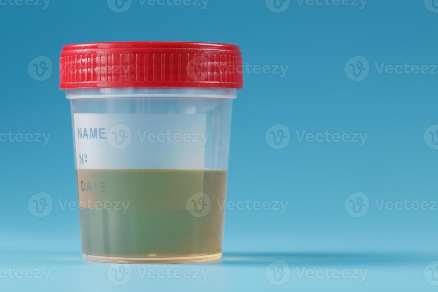 ein Behälter für Biomaterialien mit einer Urinanalyse und einem roten Deckel auf blauem Grund. foto