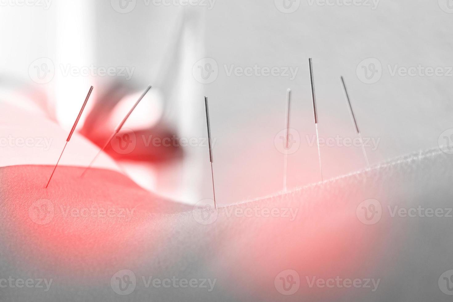 Nahaufnahme des weiblichen Körpers mit Stahlnadeln, die während des Verfahrens der Akupunkturtherapie eingesetzt werden foto