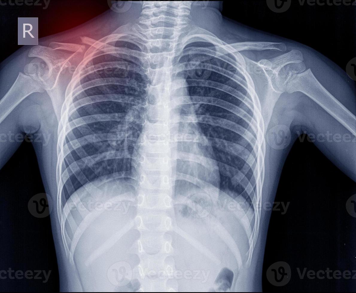 Brust-Röntgenfraktur rechtes Schlüsselbein. foto