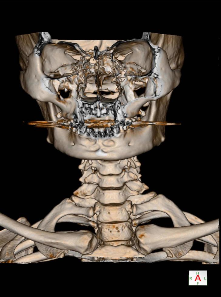 CT-Scan Halswirbelsäule 3 d render.image enthält übermäßiges Rauschen, Filmkörnung, Kompressionsartefakte. foto