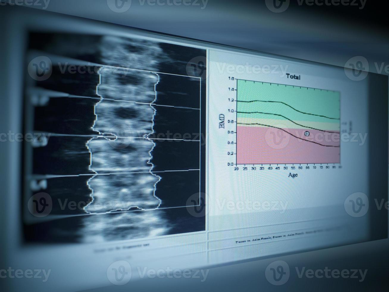 Knochendichte Lendenwirbelsäule Folge Osteoporose foto