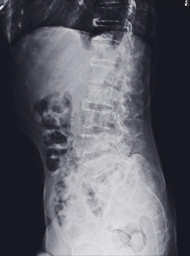 Röntgen-Lendenwirbelsäule mit multiplen Hyperdensity- und Hypodensity-Knochenläsionen an beiden Beckenknochen. foto
