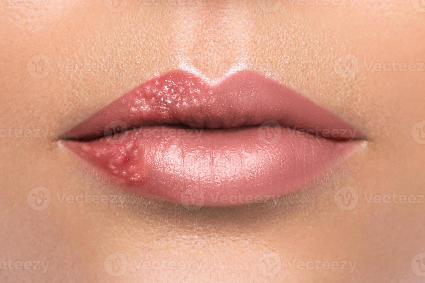 Nahaufnahme weiblicher Lippen, die vom Herpesvirus betroffen sind foto