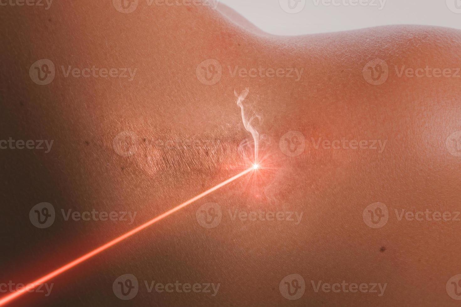 weibliche schulter und laserstrahl während der narbenentfernung foto