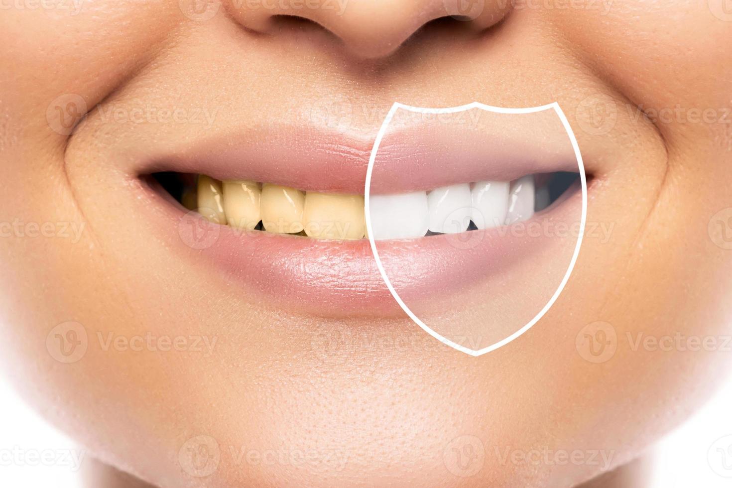 Zahnaufhellung und Hygiene. Ergebnis nach der Behandlung in einer professionellen Zahnklinik. foto