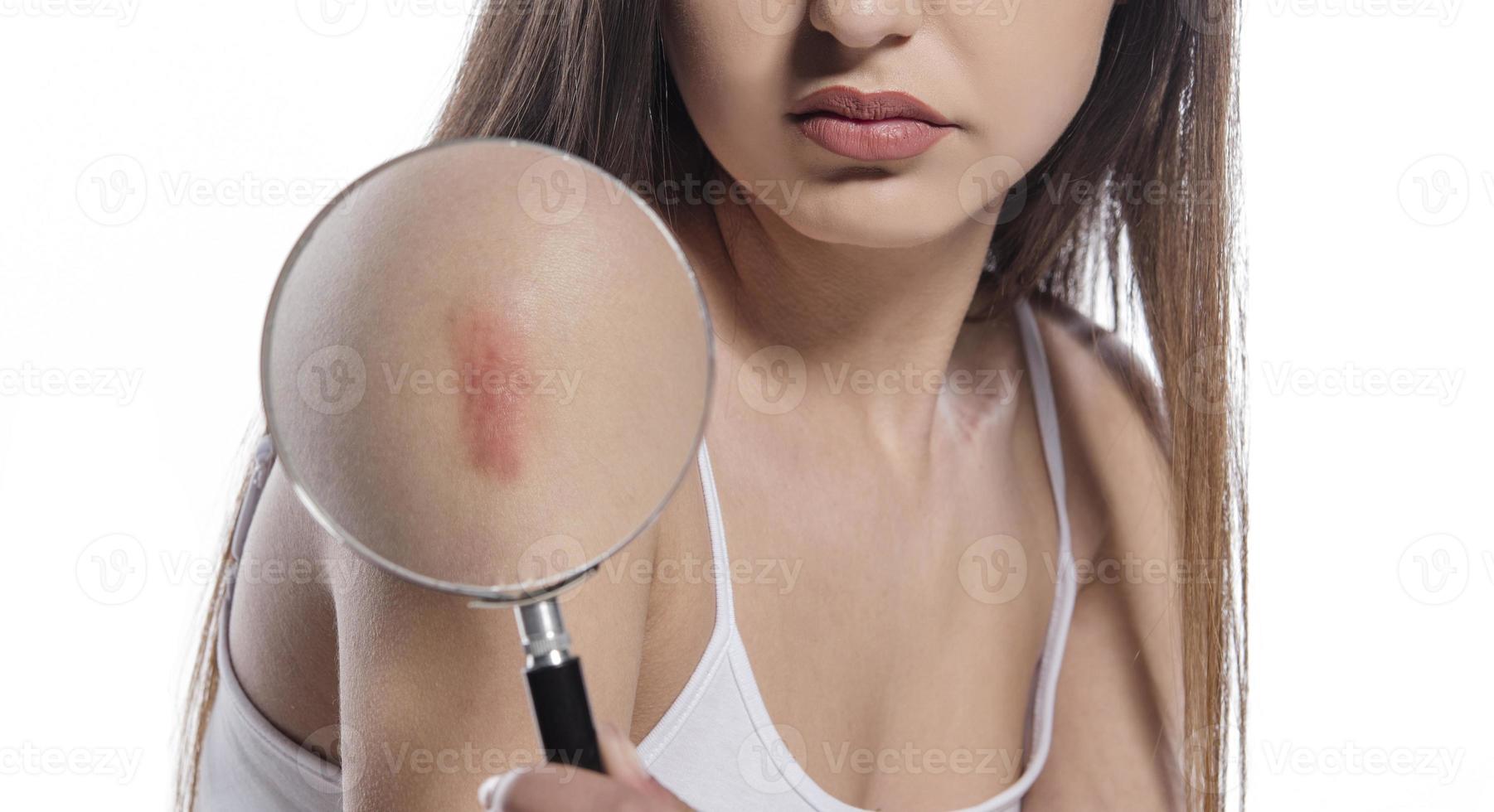 Frau mit großer hypertropher Narbe am rechten Oberarm aufgrund einer Verletzung oder Impfung foto