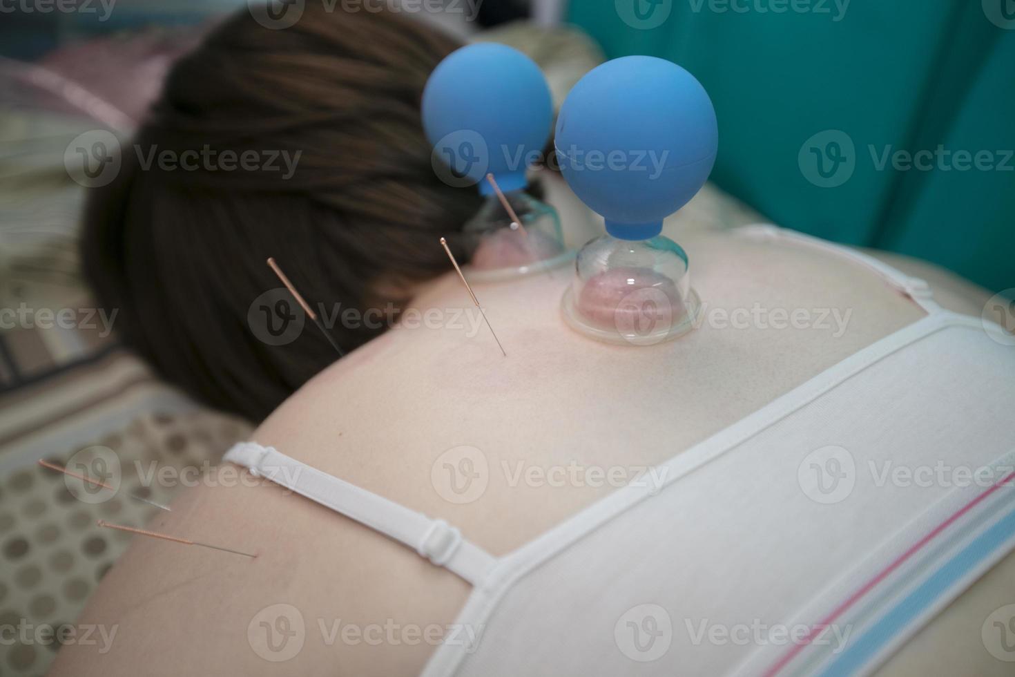 das Arzt macht das geduldig Akupunktur und Vakuum Massage. foto