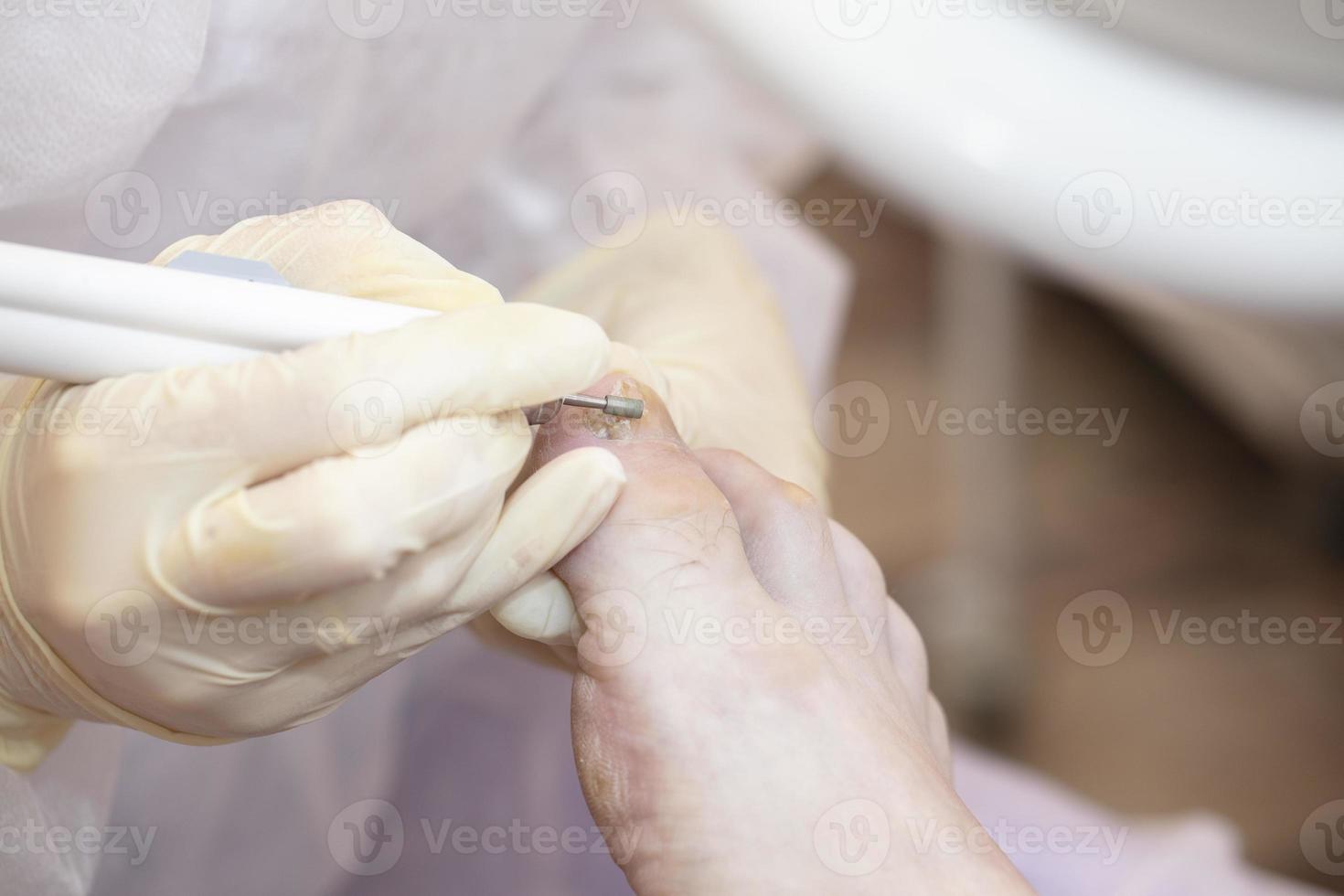 Behandlung von Zehennagel Pilz im das Krankenhaus. foto