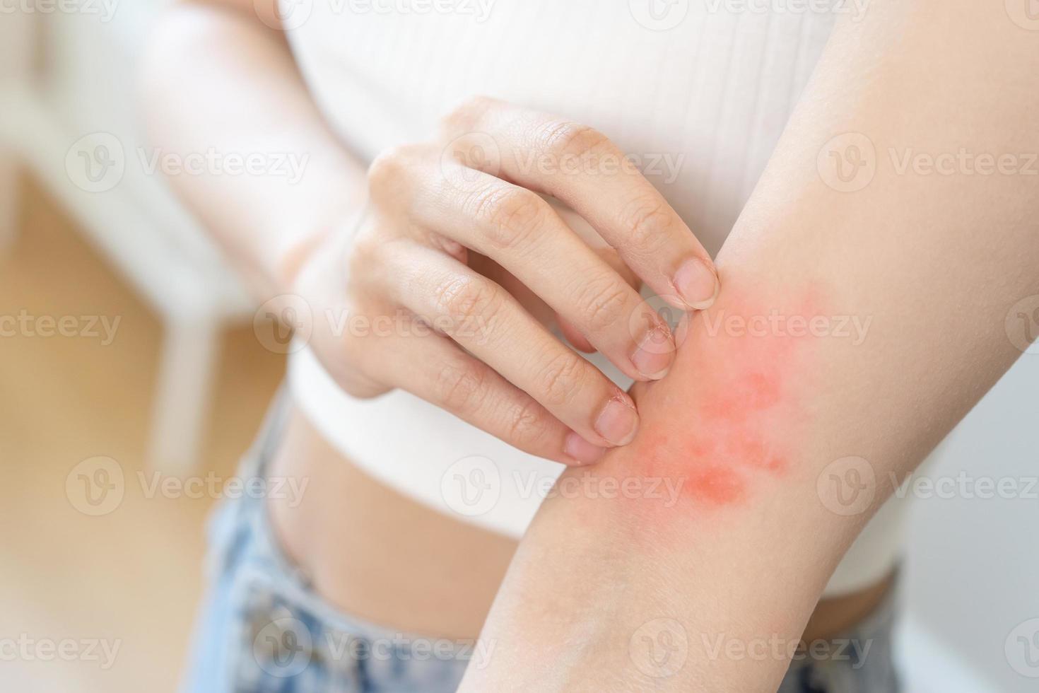 Dermatologie asiatisch jung Frau, Mädchen Allergie, allergisch Reaktion von atopisch, Insekt beißt auf ihr Arm, Hand im Kratzen juckend, jucken rot Stelle oder Ausschlag von Haut. Gesundheitspflege, Behandlung von Schönheit. foto