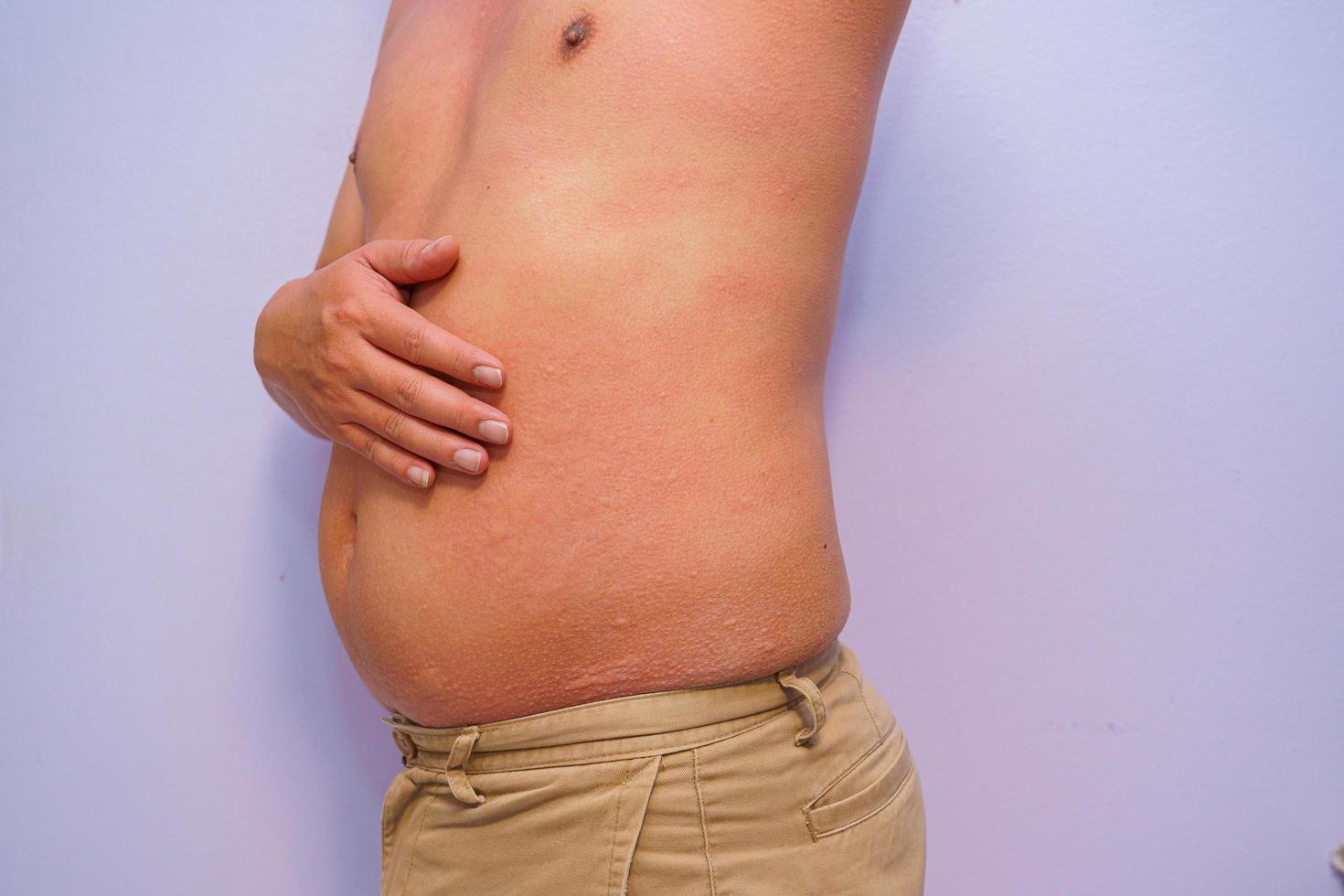 männlicher Erwachsener mit akut auftretender Nahrungsmittelallergie mit Nesselsucht am ganzen Körper foto
