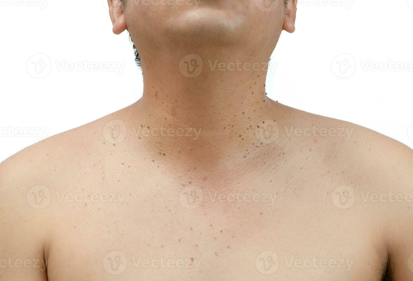 geschlossen oben das Haut Stichworte oder seborrhoisch Keratose auf Hals foto