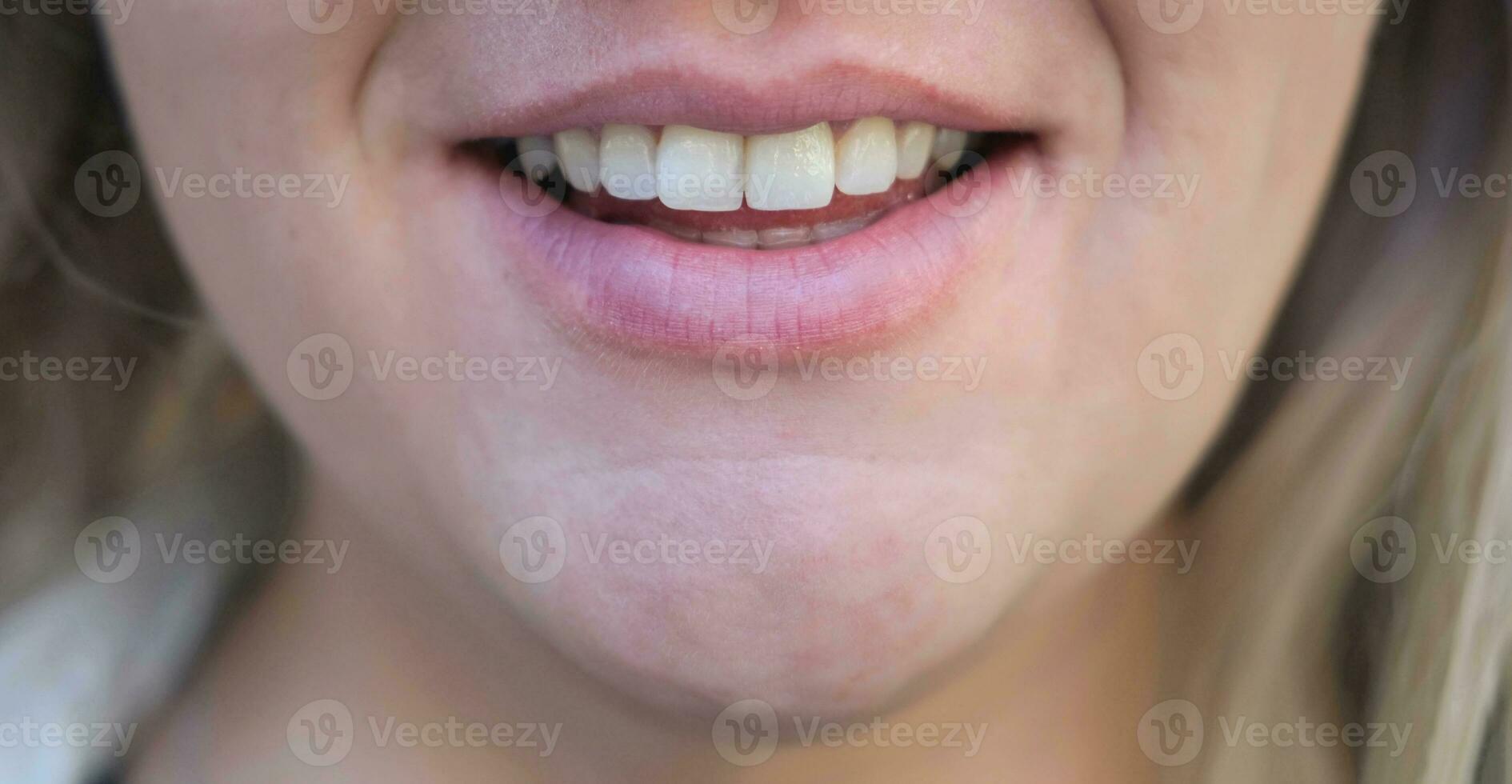 Frau Lächeln nach Dental Behandlung. Zahn Augmentation. Furniere. Nahansicht. foto