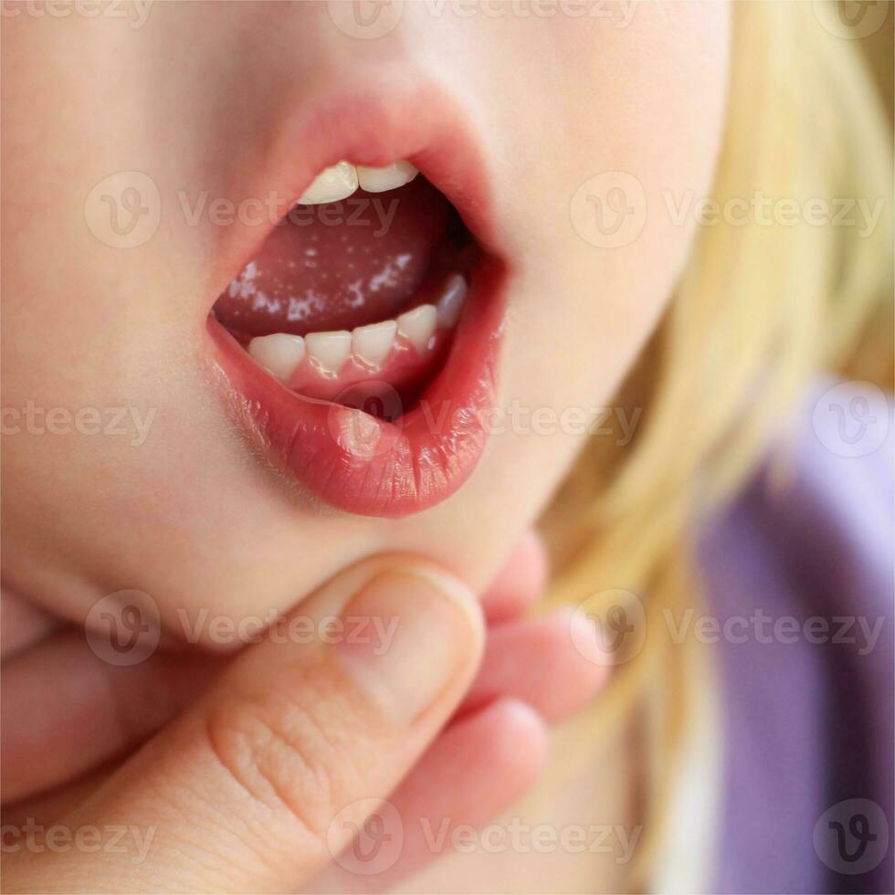 Stomatitis auf das Lippe im ein Kind foto
