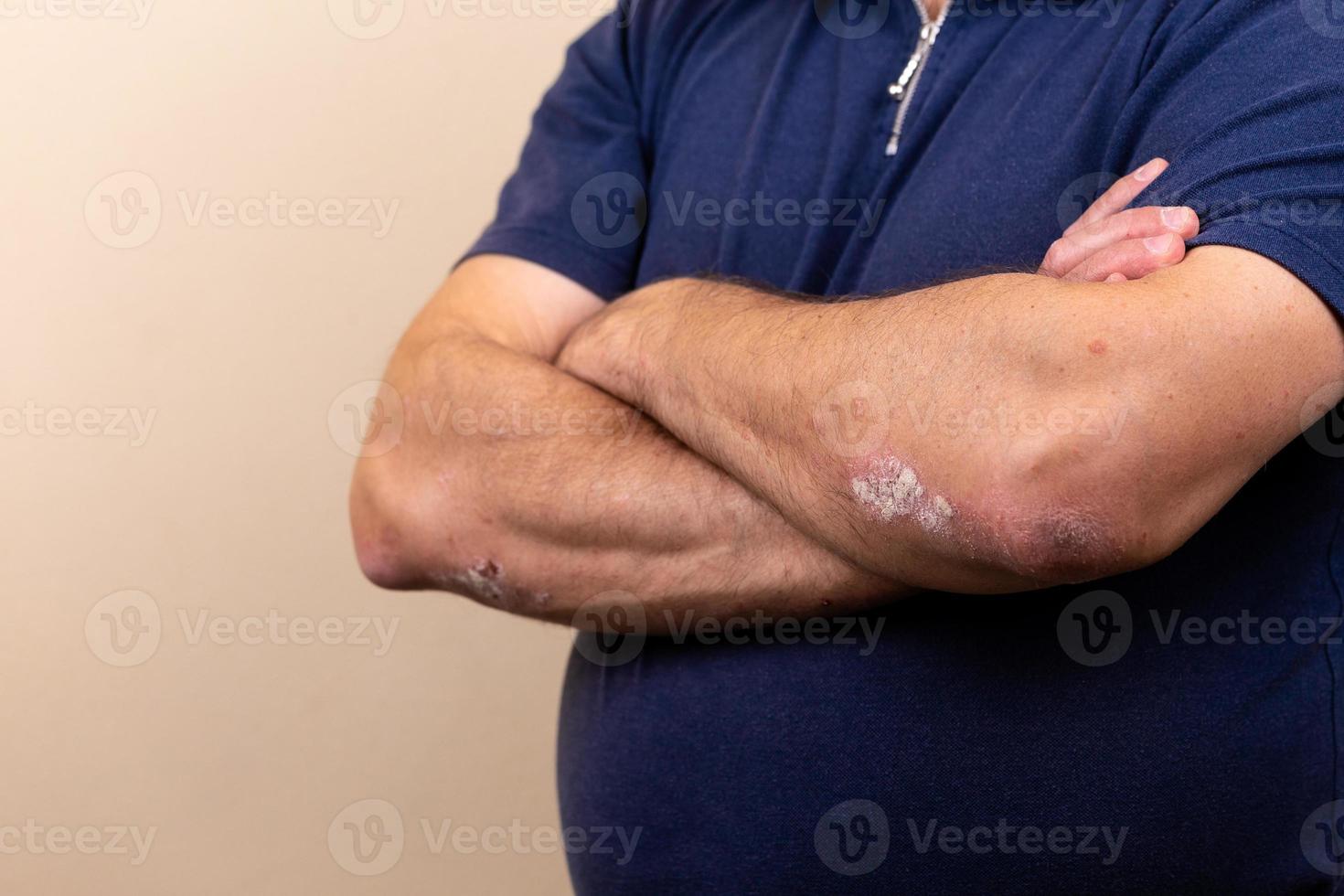 Nahaufnahme Dermatitis auf der Haut foto