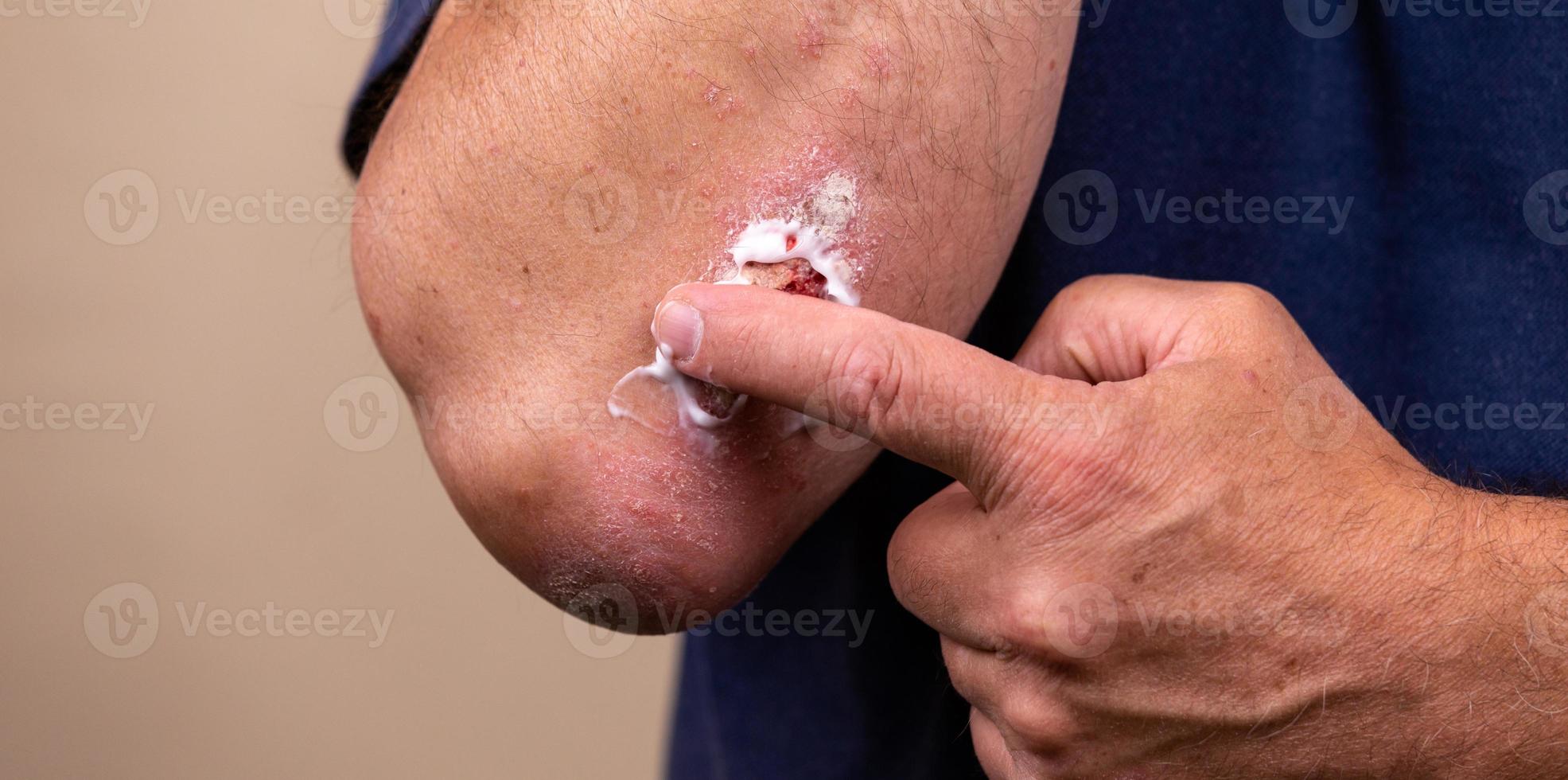Konzeptfoto der Behandlung von Hautkrankheiten mit Salben als Dosierung foto