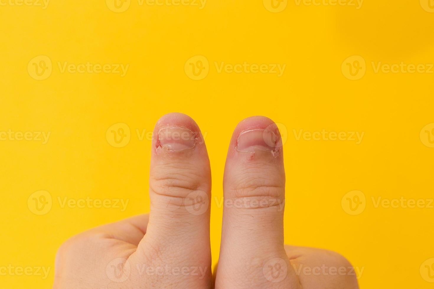 Finger mit gebissenen Nägeln lokalisiert auf gelbem Grund foto