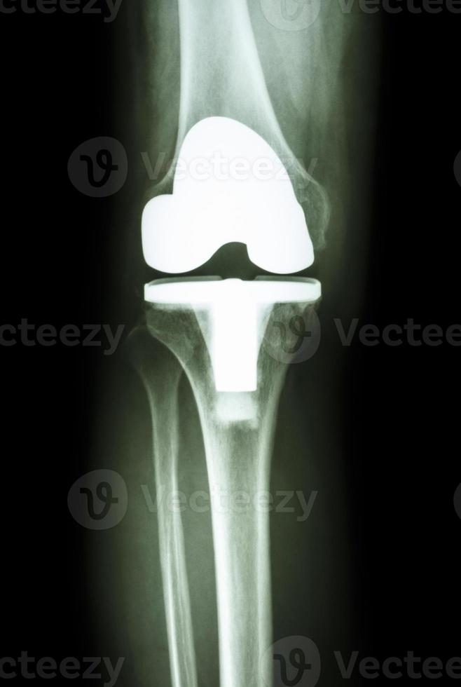 Kniegelenkprothese künstliches Gelenk von Arthrose Kniepatient oa Knie foto