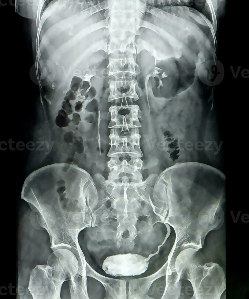 Röntgen Bild von Mensch Torso verwischen und Lärm foto