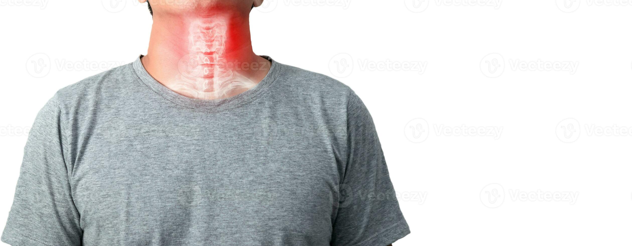 Hals Knochen zervikal Spondylose Entzündung von das zervikal Rücken foto