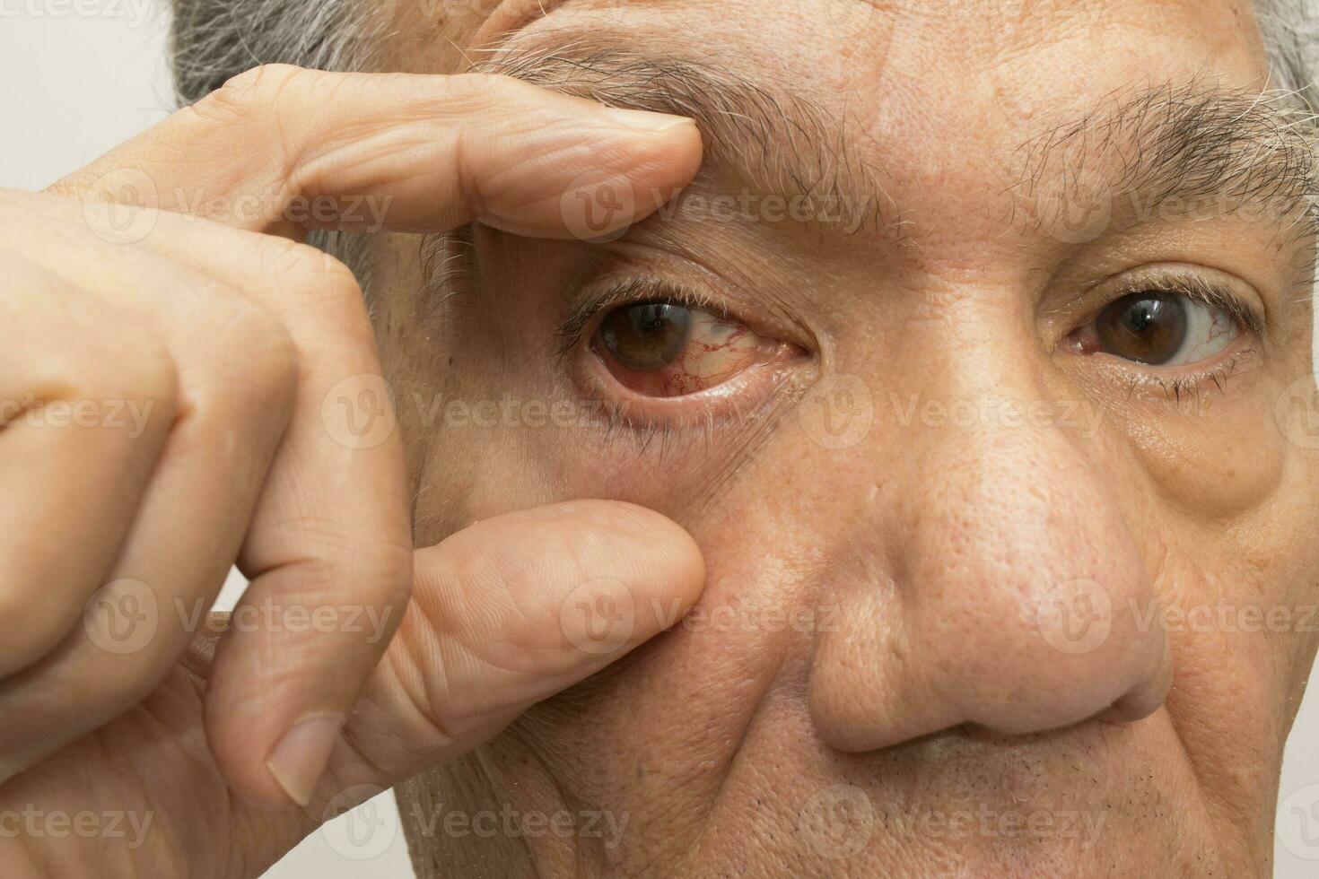 Senior Mann mit ein Rosa Auge Infektion im einer von seine Augen foto