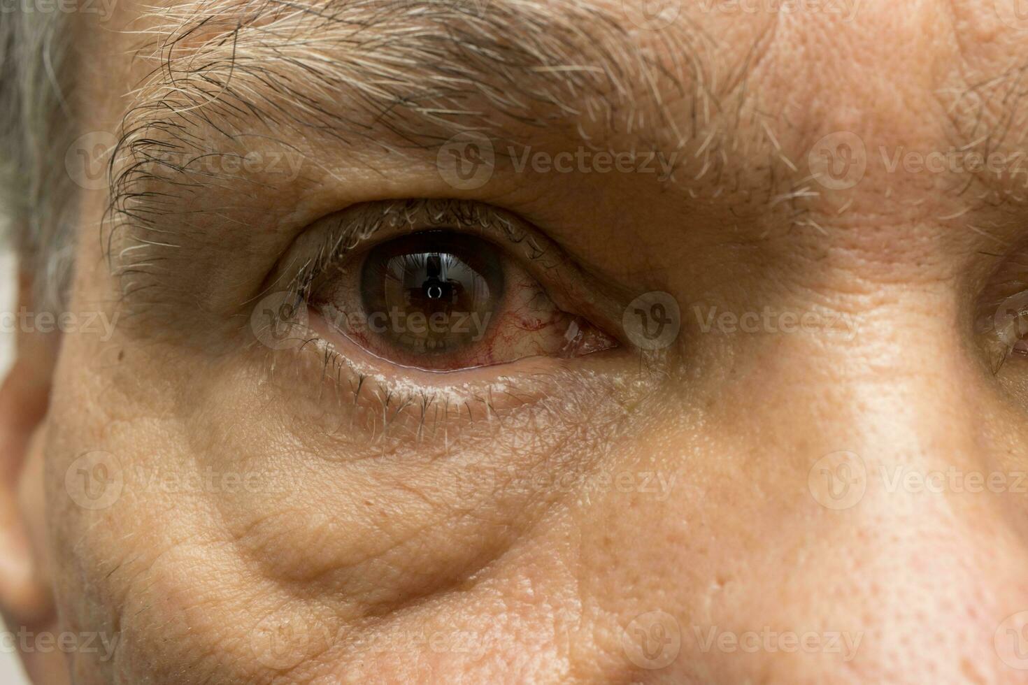 Senior Mann mit ein Rosa Auge Infektion im einer von seine Augen foto