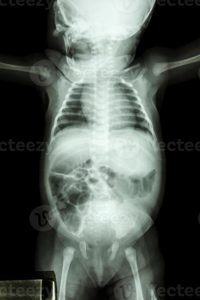 Film Röntgen des gesamten Säuglingskörpers zeigt den normalen Säuglingskörper foto