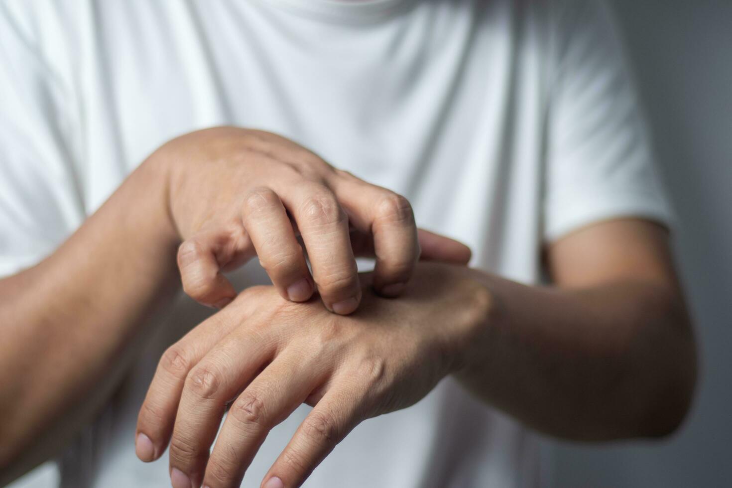 Mann Kratzen seine Hand. medizinisch Konzept. foto