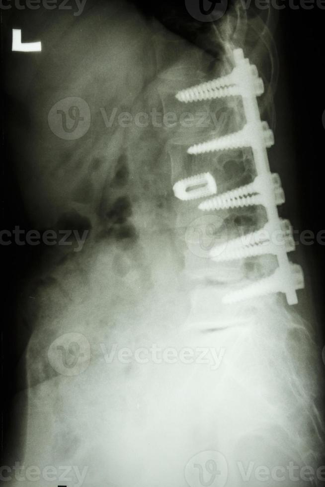 Filmröntgen zeigen Lendenwirbelsäule mit Pedikelschraubenfixation bei Spondylolithese-Patienten foto