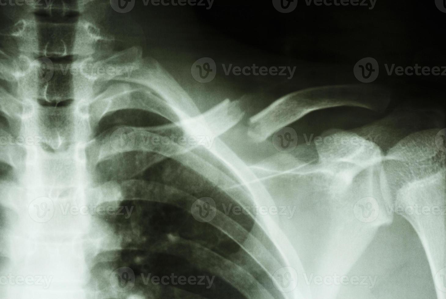 Film Röntgen zeigen komplette Fraktur Mitte links Schlüsselbein foto