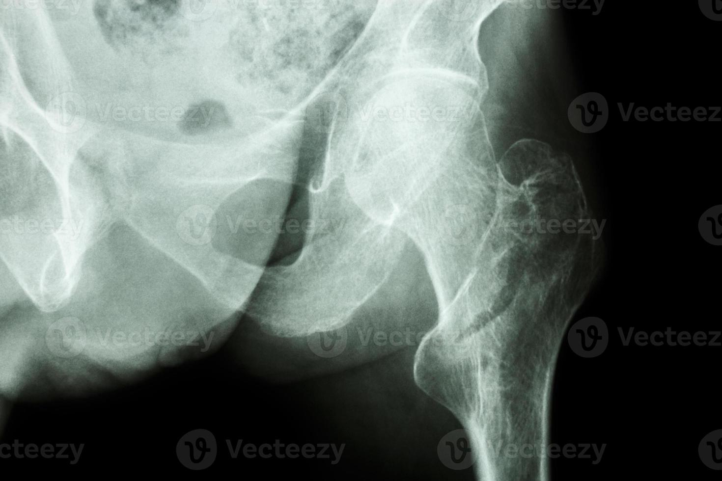 Film Röntgenaufnahme zeigen intertrochantäre Fraktur linken Femur foto