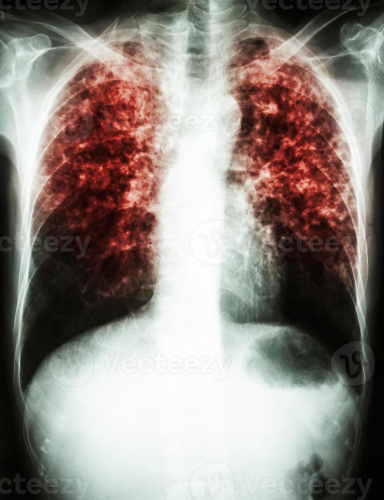 Lungentuberkulose-Film Röntgen-Thorax zeigen interstitielle Infiltrierung beider Lungen aufgrund einer Mycobacterium-Tuberkulose-Infektion foto