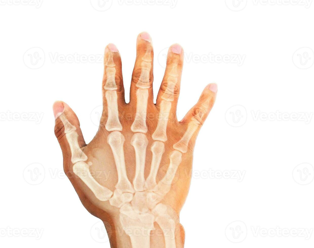 geröntgt Mensch Hand. Röntgen von Hand Knochen foto
