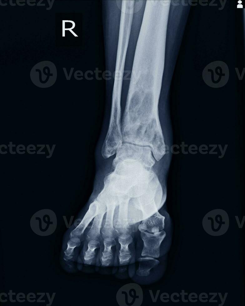 Röntgen rt.knöchel finden intramedullär osterolytisch Läsion von richtig distal Tibia foto