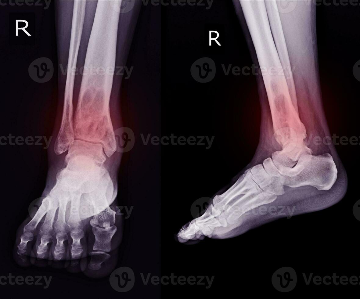 Röntgen rt.knöchel finden intramedullär osterolytisch Läsion von richtig distal Tibia foto