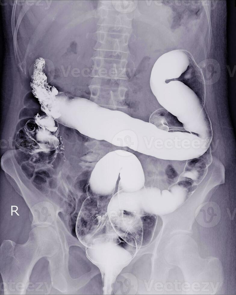 Besondere Untersuchung Barium Einlauf ein weiblich 54 Jahr alt. foto