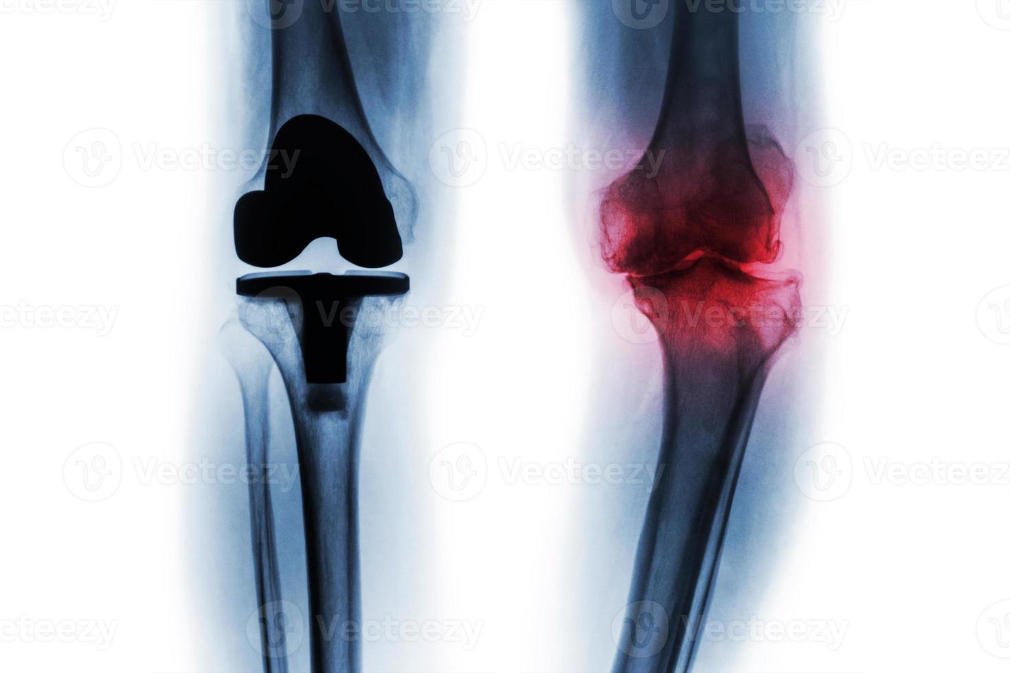 Filmröntgenbild eines Kniepatienten mit Osteoarthritis und eines künstlichen Gelenk-Total-Knieersatzes. isolierter Hintergrund. foto