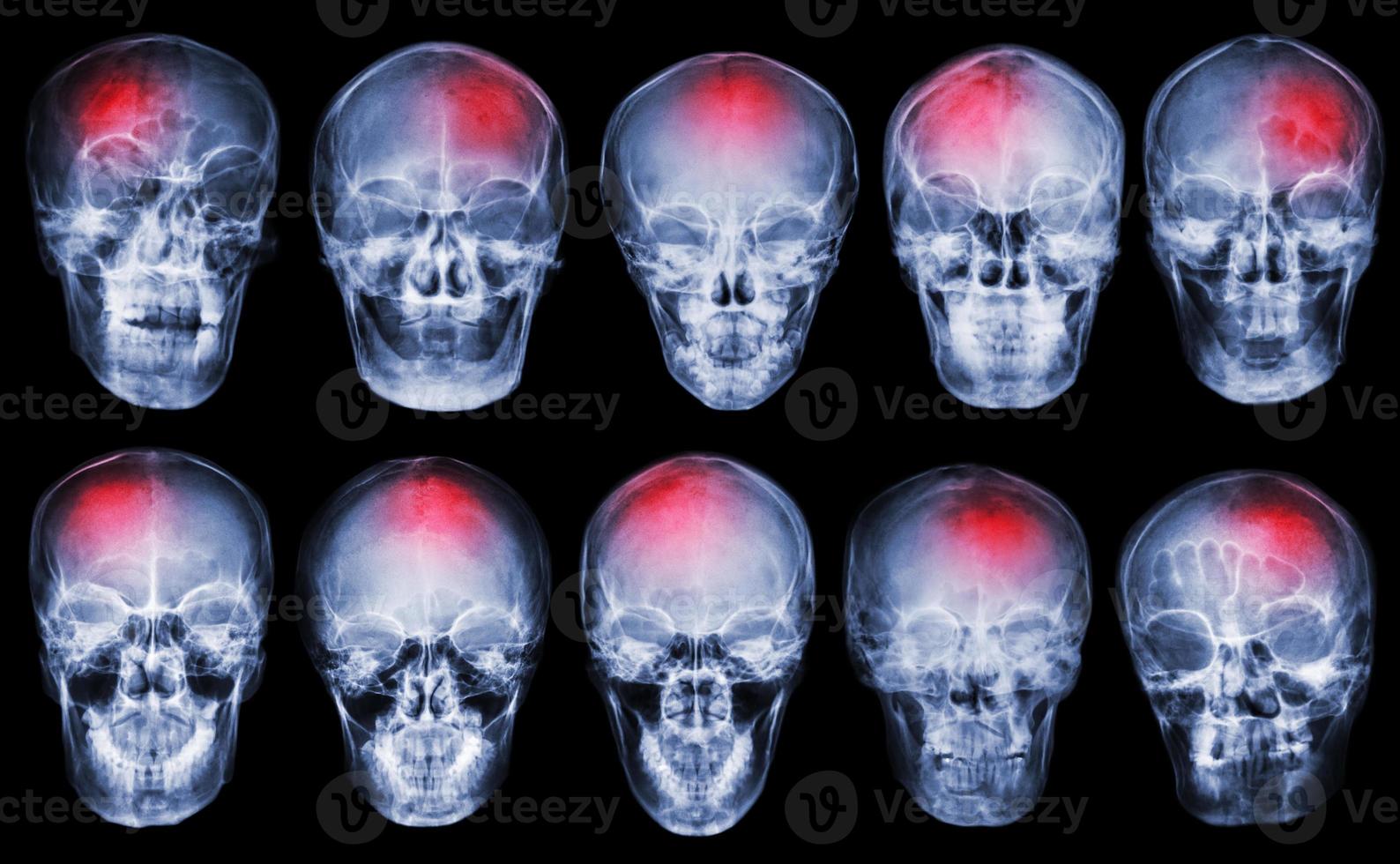 Schlaganfall . Schlaganfall . Set aus Filmröntgenschädel foto