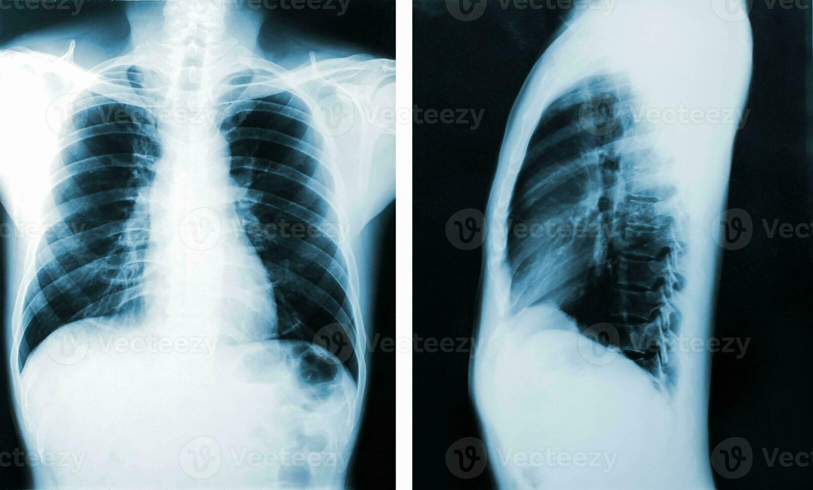 Röntgenbild, Ansicht von Brustmännern zur medizinischen Diagnose. foto